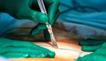 ניתוח שרוול קיבה - תמונת המחשה